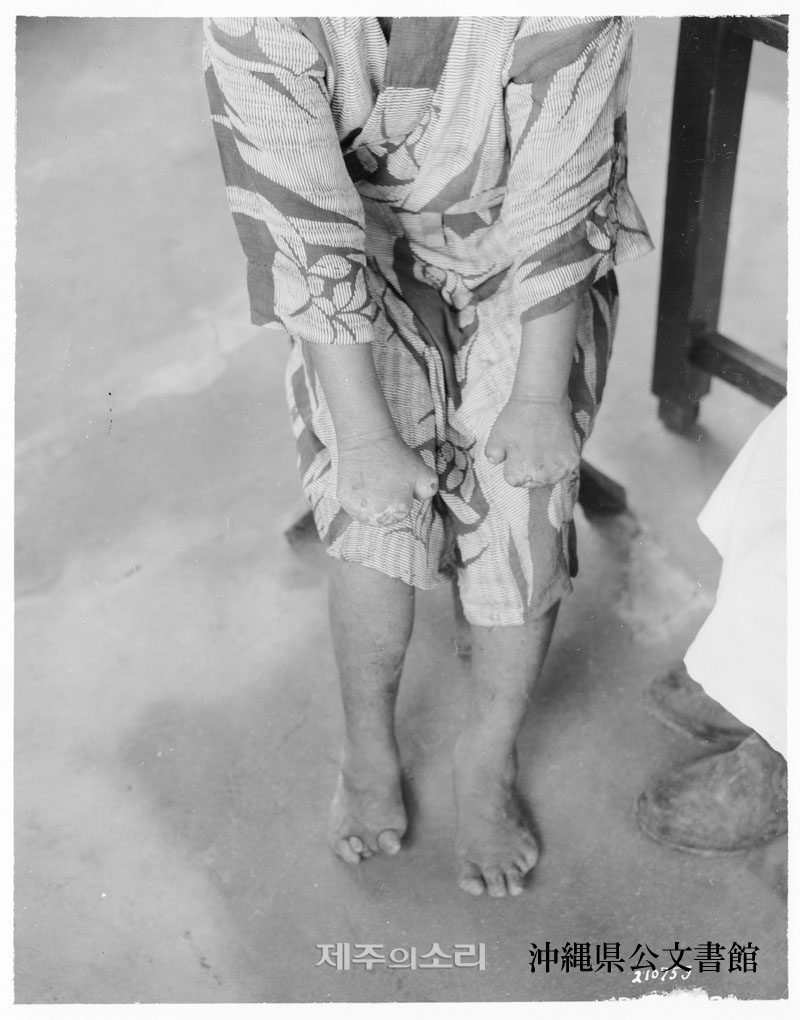1945년 미군 사진, 소녀 환자, 오키나와 애락원. 제공=토미야마 카즈미. ⓒ제주의소리