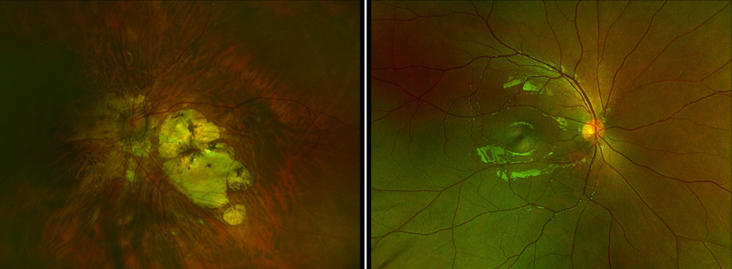 사진 왼쪽은 고도 근시 망막, 사진 오른쪽은 정상 망막 / 사진 = 강병수 원장 제공 ⓒ제주의소리