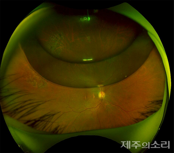 [﻿사진2] 망막박리 수술 받고 1주가 지난 환자의 망막 사진. 수술 후 가스가 안구내에 남아 있는 모습(상측)이 관찰된다. ⓒ제주의소리