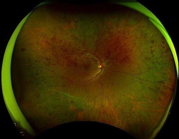 망막분지정맥폐쇄의 오른쪽 눈 망막사진. 망막 위쪽 절반에 광범위하게 망막출혈이 관찰된다. ⓒ제주의소리