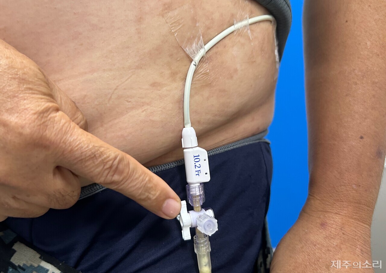 몸 밖으로 소변을 배출하는 요관. ⓒ제주의소리